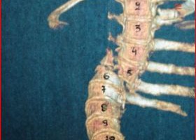 Case: Μ. Ch. – Thoracic Spinal Injury: Οperative treatment and related problems