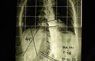Περίπτωση Μα. Μι. – Σκολίωση Ενήλικος Χειρουργηθείσα- Παραμορφώσεις Σπονδυλικής Στήλης