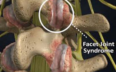 Η χρήση των Μεσεγχυματικών Βλαστοκυττάρων στην εκφύλιση των Σπονδυλικών Διαρθρώσεων  (Facet Symdrome)