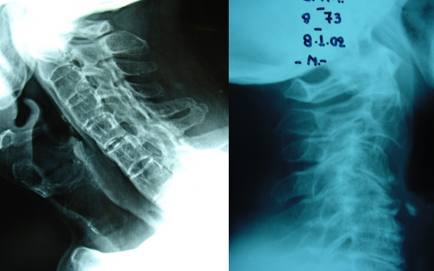 Cervical Spine Deformities 2019